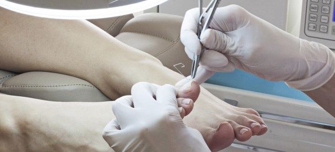 удаление вросшего ногтя удаление вросшего ногтя