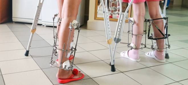 удлинение ног аппаратом Илизарова удлинение ног аппаратом Илизарова