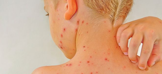 через сколько дней после заражения проявляется ветрянка через сколько дней после заражения проявляется ветрянка