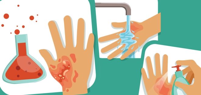 что делать при химическом ожоге что делать при химическом ожоге