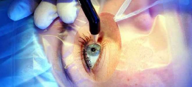 кератоконус операция кератоконус операция