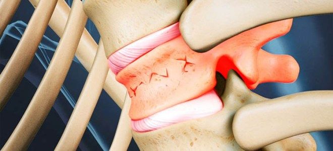 контузия позвоночника контузия позвоночника