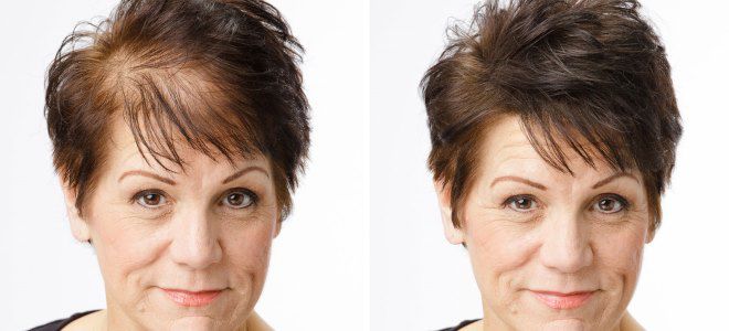 миноксидил для волос применение миноксидил для волос применение