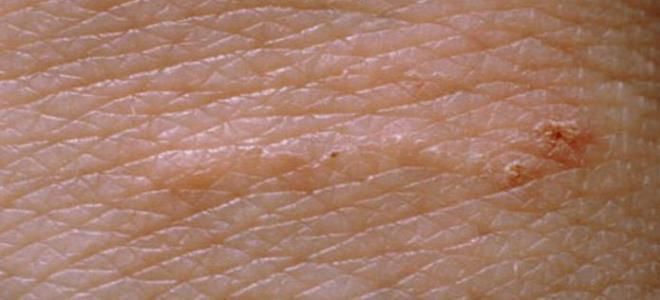 первые признаки чесотки первые признаки чесотки