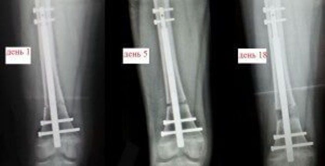 precise nail precise nail