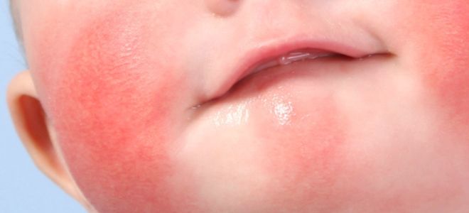 Сыпь при дисбактериозе у грудничков вид Сыпь при дисбактериозе у грудничков вид