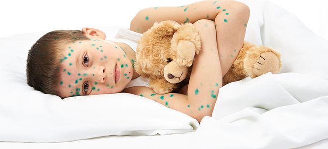 как предотвратить заражение ветрянкой как предотвратить заражение ветрянкой