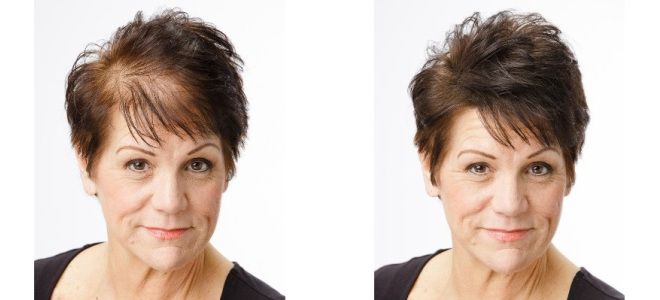 Плазмолифтинг для роста волос до после Плазмолифтинг для роста волос до после