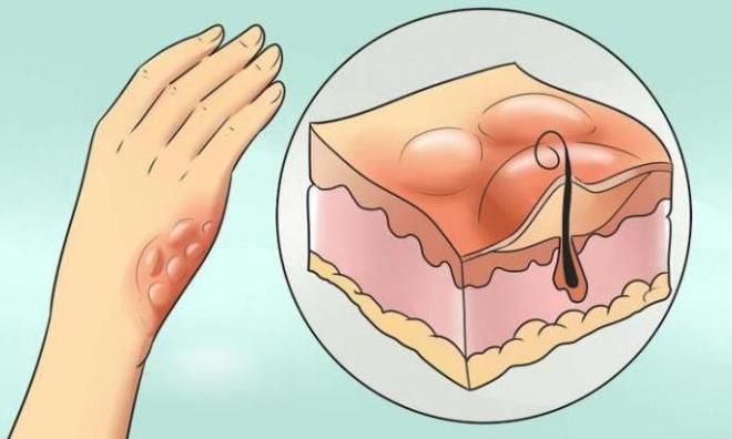 волдыри после ожога что делать волдыри после ожога что делать